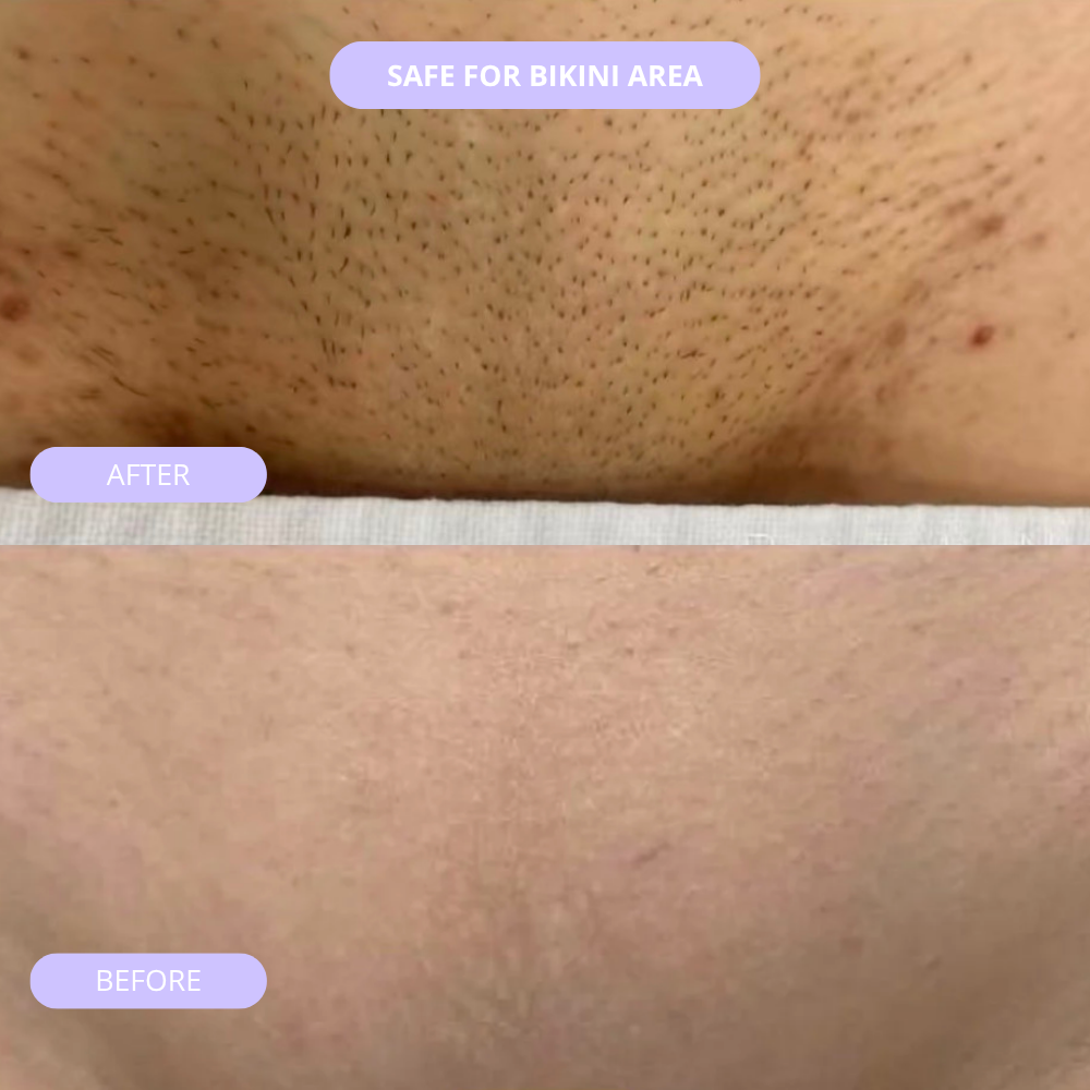 REMOVV IPL Hair Eraser