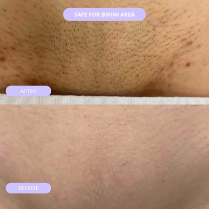 REMOVV IPL Hair Eraser